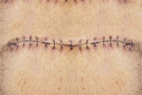 deiscência de sutura